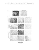 TISSUE & BLOOD-BASED MIRNA BIOMARKERS FOR THE DIAGNOSIS, PROGNOSIS AND     METASTASIS-PREDICTIVE POTENTIAL IN COLORECTAL CANCER diagram and image