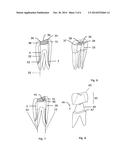METHOD AND SYSTEM FOR ESTABLISHING THE SHAPE OF THE OCCLUSAL ACCESS CAVITY     IN ENDODONTIC TREATMENT diagram and image