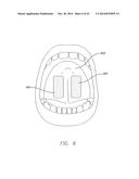 APPARATUS AND METHOD FOR TREATING OBSTRUCTIVE SLEEP APNEA diagram and image