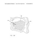 APPARATUS AND METHOD FOR TREATING OBSTRUCTIVE SLEEP APNEA diagram and image