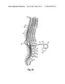 ANCHOR SLEEVE FOR IMPLANTABLE LEAD diagram and image