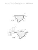 WOUND DRESSING OF CONTINUOUS FIBERS diagram and image