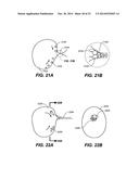 DEVICES AND METHODS FOR DELIVERING ACTIVE AGENTS TO THE OSTEOMEATAL     COMPLEX diagram and image