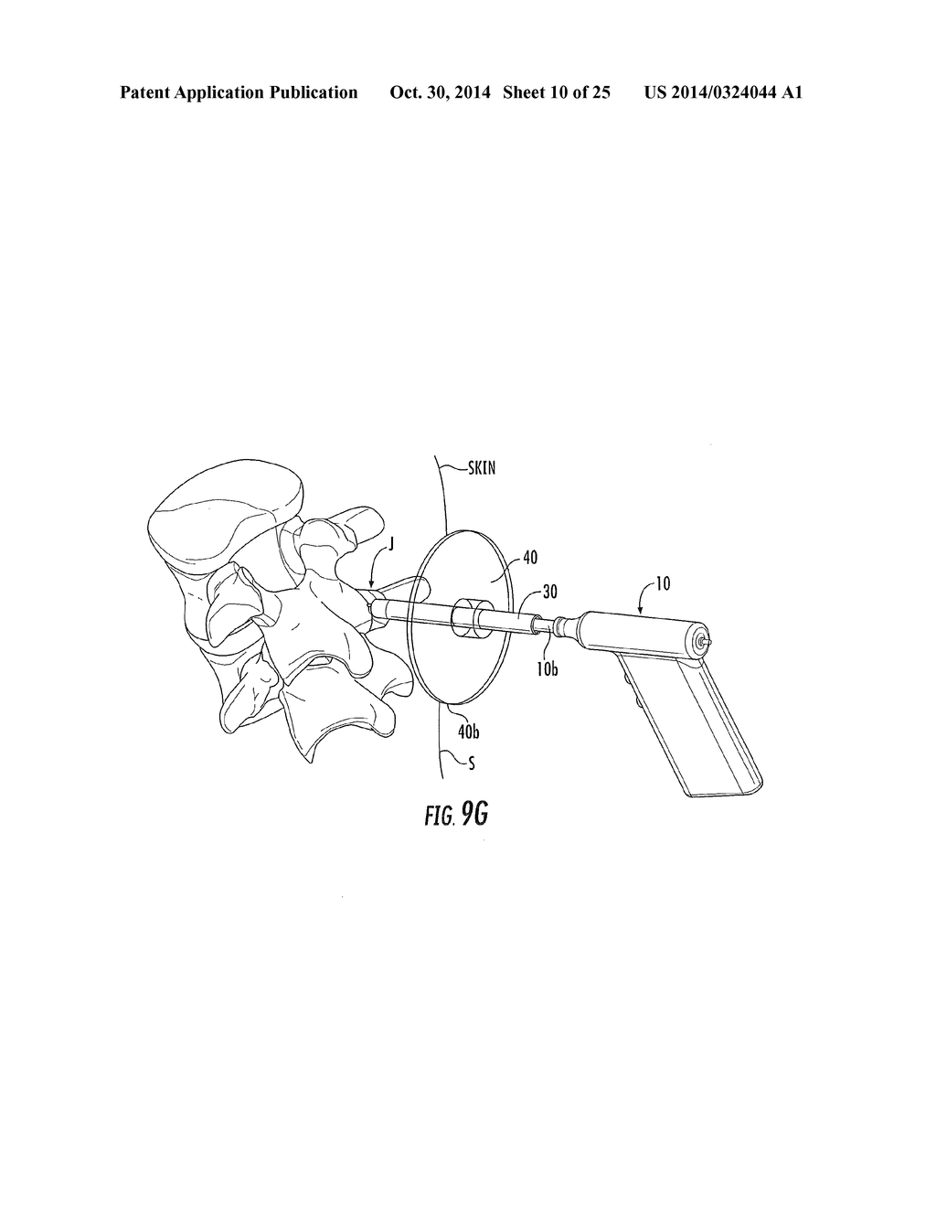 MINIMALLY INVASIVE METHODS FOR SPINAL FACET THERAPY TO ALLEVIATE PAIN AND     ASSOCIATED SURGICAL TOOLS, KITS AND INSTRUCTIONAL MEDIA - diagram, schematic, and image 11