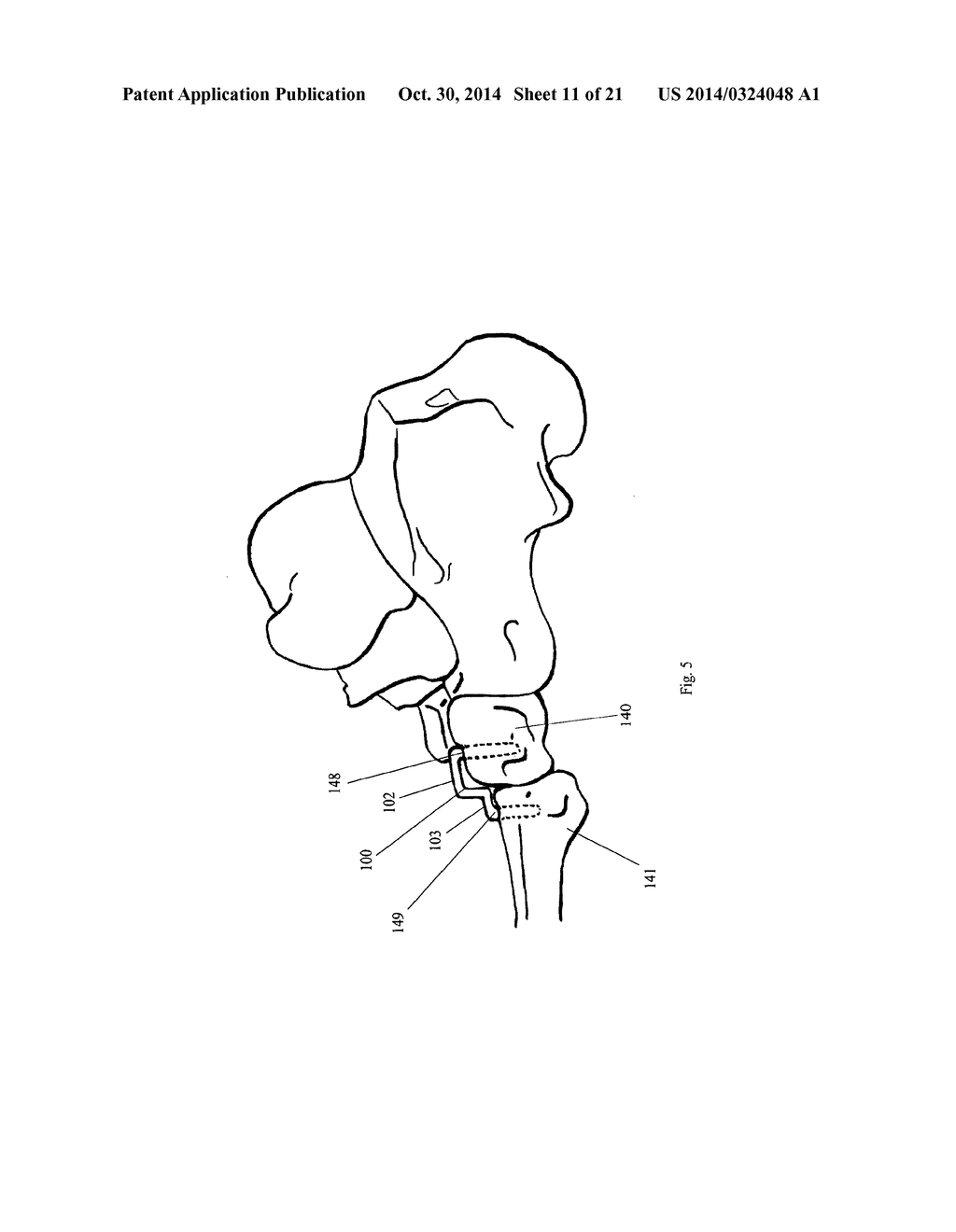 METHODS AND APPARATUS FOR A STAPLE - diagram, schematic, and image 12