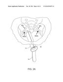 SYSTEM AND METHOD FOR PELVIC FLOOR REPAIR diagram and image