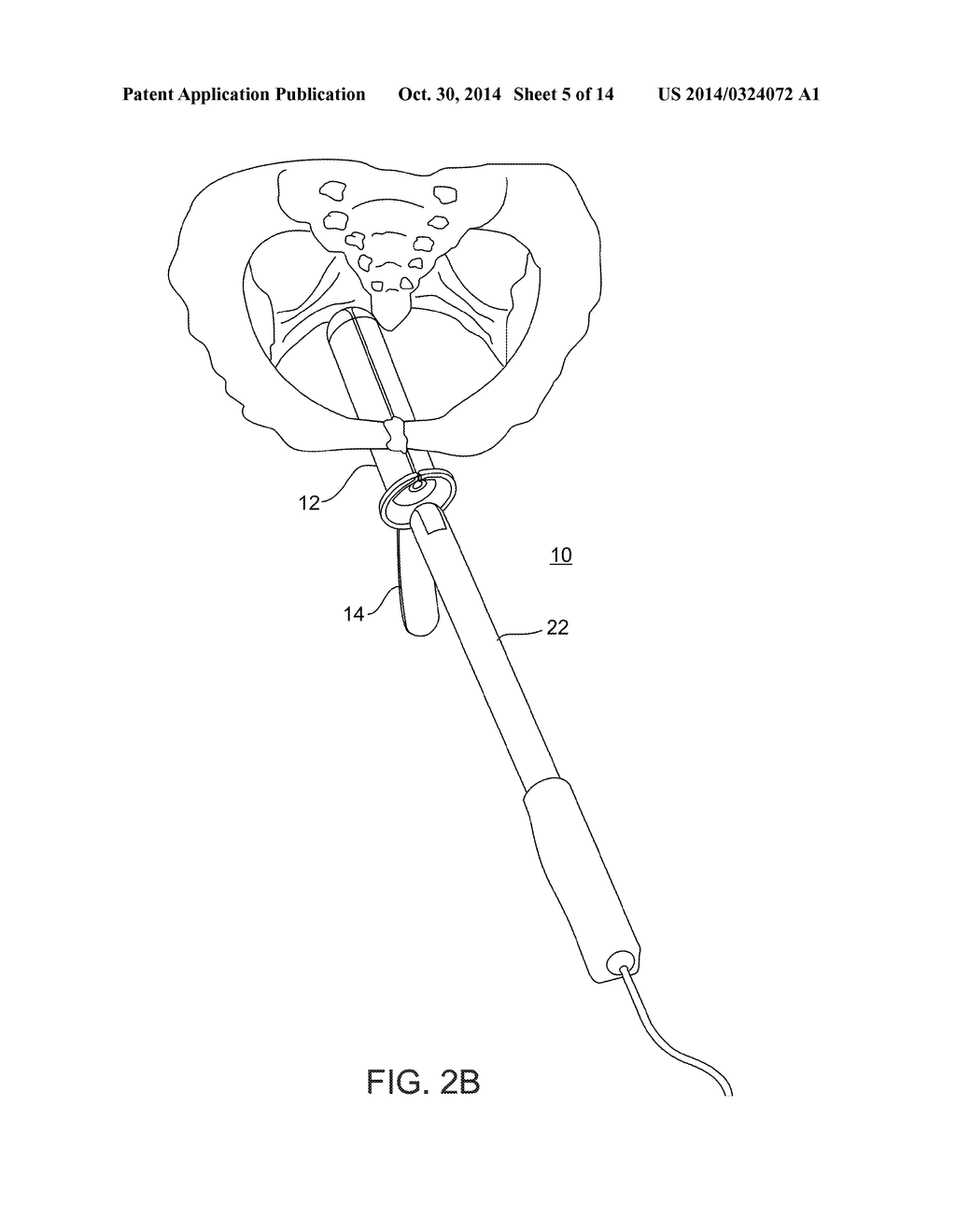 SYSTEM AND METHOD FOR PELVIC FLOOR REPAIR - diagram, schematic, and image 06