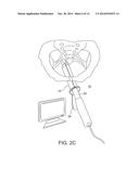 SYSTEM AND METHOD FOR PELVIC FLOOR REPAIR diagram and image