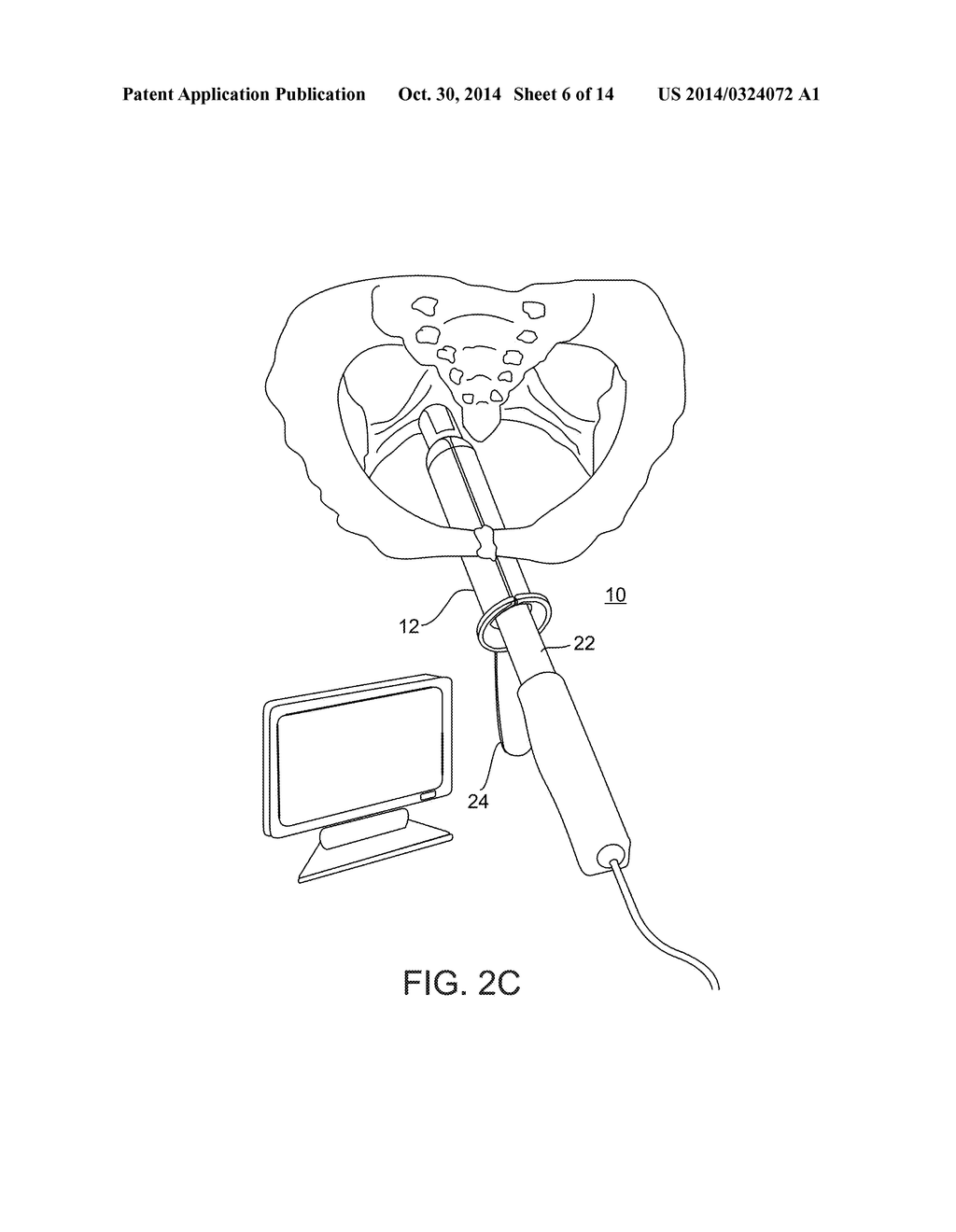 SYSTEM AND METHOD FOR PELVIC FLOOR REPAIR - diagram, schematic, and image 07