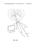 SYSTEM AND METHOD FOR PELVIC FLOOR REPAIR diagram and image