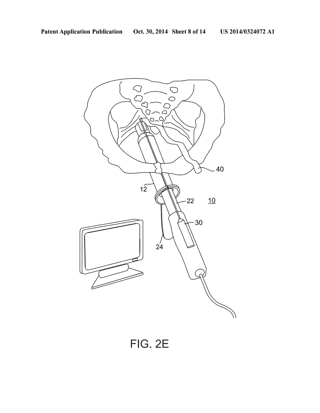 SYSTEM AND METHOD FOR PELVIC FLOOR REPAIR - diagram, schematic, and image 09