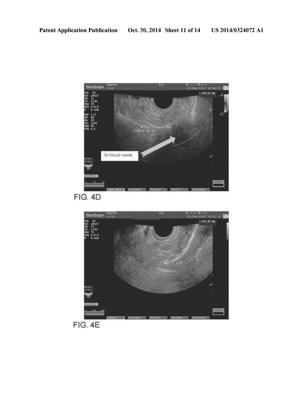 SYSTEM AND METHOD FOR PELVIC FLOOR REPAIR - diagram, schematic, and image 12