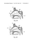 DEVICES, SYSTEMS AND METHODS USEABLE FOR TREATING SINUSITIS diagram and image