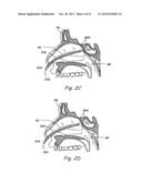 DEVICES, SYSTEMS AND METHODS USEABLE FOR TREATING SINUSITIS diagram and image