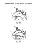 DEVICES, SYSTEMS AND METHODS USEABLE FOR TREATING SINUSITIS diagram and image