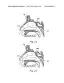 DEVICES, SYSTEMS AND METHODS USEABLE FOR TREATING SINUSITIS diagram and image