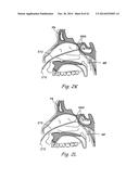 DEVICES, SYSTEMS AND METHODS USEABLE FOR TREATING SINUSITIS diagram and image