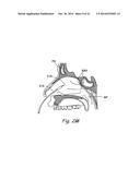 DEVICES, SYSTEMS AND METHODS USEABLE FOR TREATING SINUSITIS diagram and image