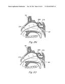 DEVICES, SYSTEMS AND METHODS USEABLE FOR TREATING SINUSITIS diagram and image