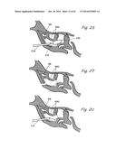 DEVICES, SYSTEMS AND METHODS USEABLE FOR TREATING SINUSITIS diagram and image