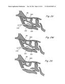 DEVICES, SYSTEMS AND METHODS USEABLE FOR TREATING SINUSITIS diagram and image