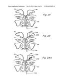 DEVICES, SYSTEMS AND METHODS USEABLE FOR TREATING SINUSITIS diagram and image