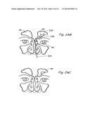 DEVICES, SYSTEMS AND METHODS USEABLE FOR TREATING SINUSITIS diagram and image