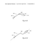 DEVICES, SYSTEMS AND METHODS USEABLE FOR TREATING SINUSITIS diagram and image