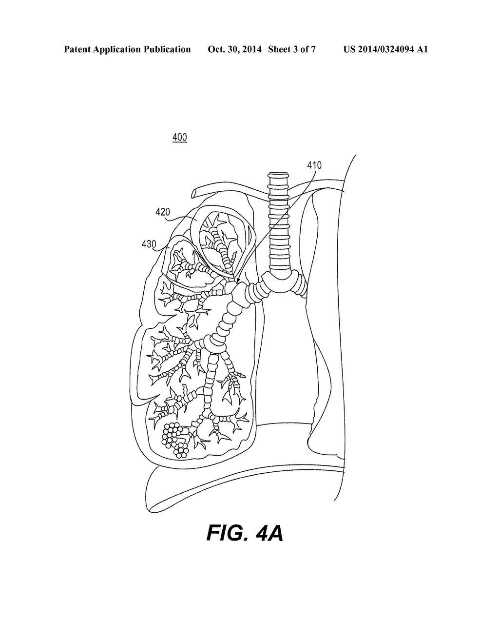 DEVICES FOR OBSTRUCTING PASSAGE OF AIR OR OTHER CONTAMINANTS INTO A     PORTION OF A LUNG AND METHODS OF USE - diagram, schematic, and image 04