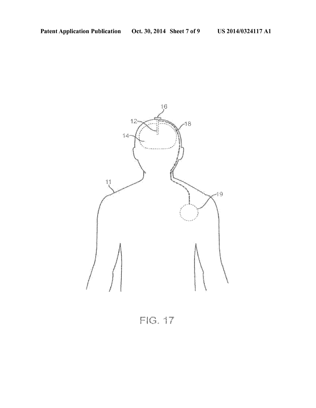 LEAD AND METHODS FOR BRAIN MONITORING AND MODULATION - diagram, schematic, and image 08