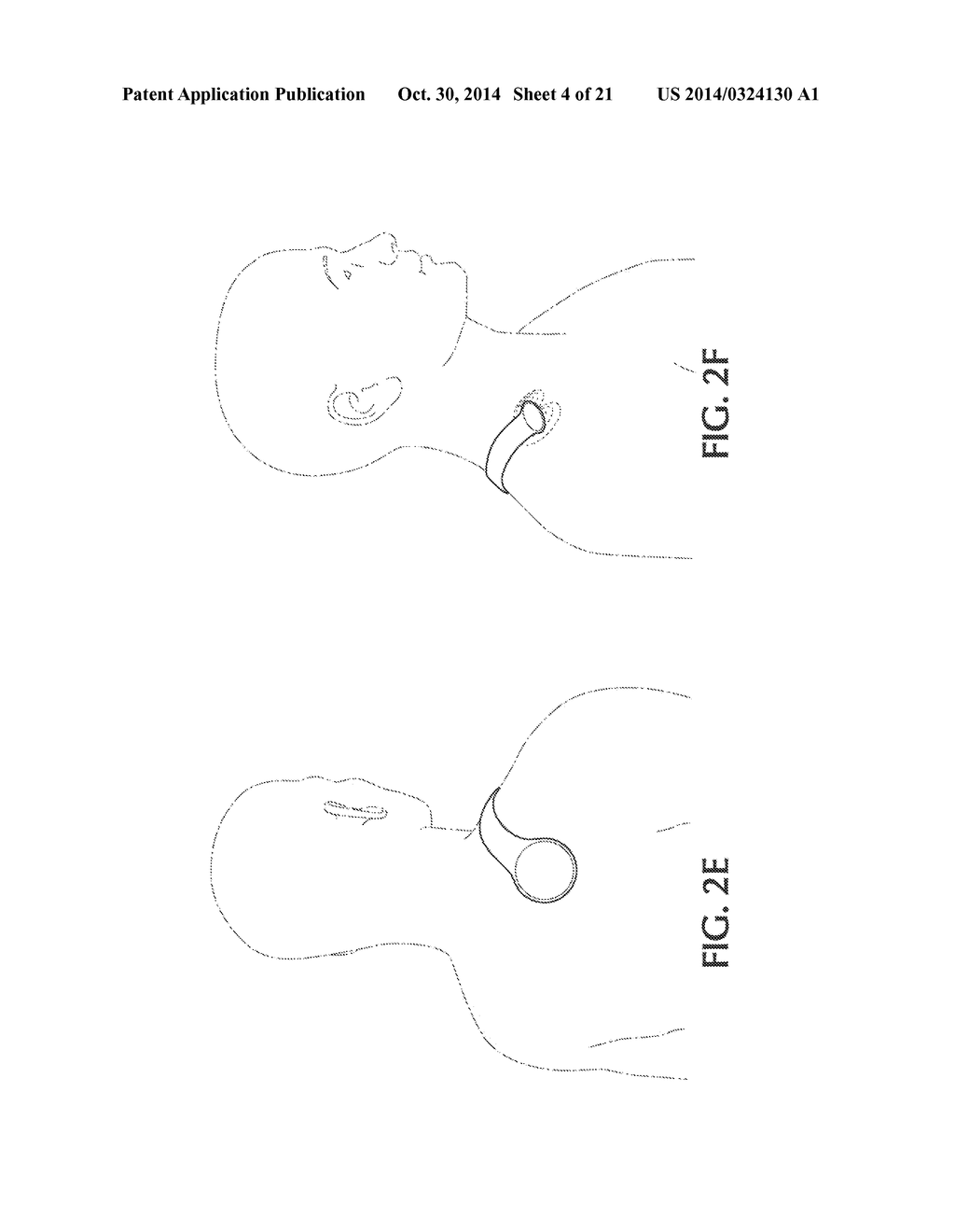 DEVICE AND METHOD FOR SELF-POSITIONING OF A STIMULATION DEVICE TO ACTIVATE     BROWN ADIPOSE TISSUE DEPOT IN SUPRACLAVICULAR FOSSA REGION - diagram, schematic, and image 05