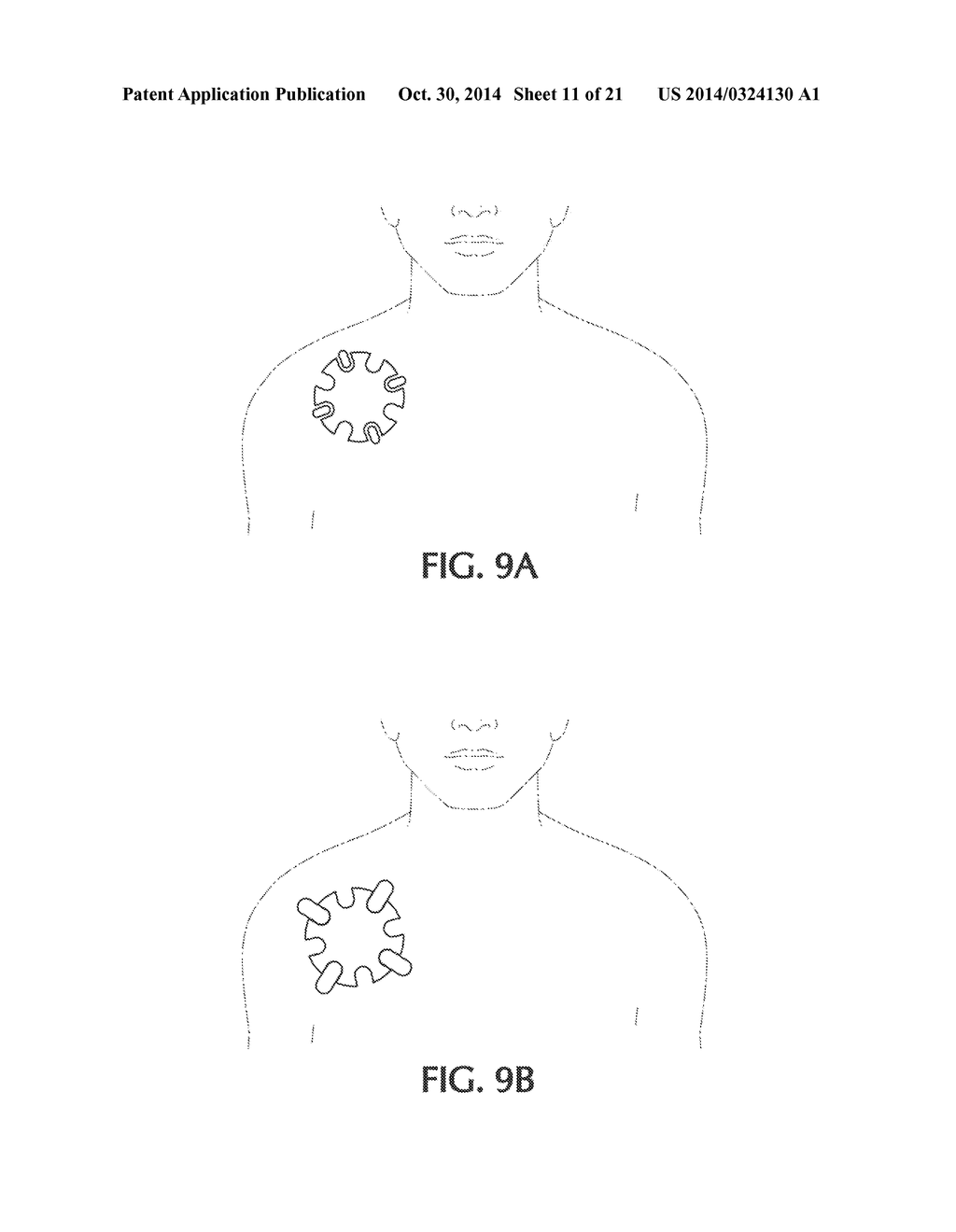 DEVICE AND METHOD FOR SELF-POSITIONING OF A STIMULATION DEVICE TO ACTIVATE     BROWN ADIPOSE TISSUE DEPOT IN SUPRACLAVICULAR FOSSA REGION - diagram, schematic, and image 12