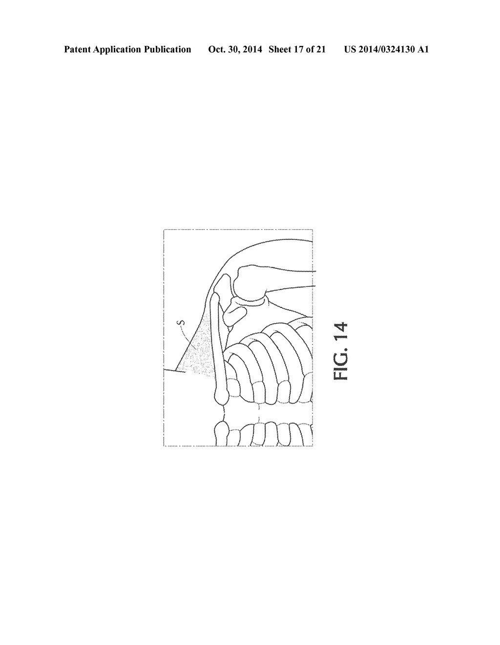 DEVICE AND METHOD FOR SELF-POSITIONING OF A STIMULATION DEVICE TO ACTIVATE     BROWN ADIPOSE TISSUE DEPOT IN SUPRACLAVICULAR FOSSA REGION - diagram, schematic, and image 18