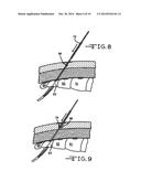 MINIMALLY INVASIVE METHODS FOR IMPLANTING A SACRAL STIMULATION LEAD diagram and image