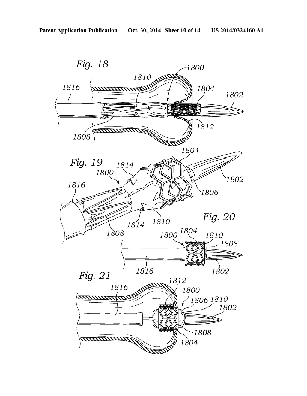 LOW-PROFILE HEART VALVE AND DELIVERY SYSTEM - diagram, schematic, and image 11