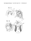 TECHNIQUES FOR PERCUTANEOUS MITRAL VALVE REPLACEMENT AND SEALING diagram and image