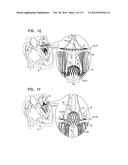 TECHNIQUES FOR PERCUTANEOUS MITRAL VALVE REPLACEMENT AND SEALING diagram and image