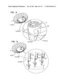 TECHNIQUES FOR PERCUTANEOUS MITRAL VALVE REPLACEMENT AND SEALING diagram and image