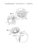 TECHNIQUES FOR PERCUTANEOUS MITRAL VALVE REPLACEMENT AND SEALING diagram and image