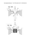 TECHNIQUES FOR PERCUTANEOUS MITRAL VALVE REPLACEMENT AND SEALING diagram and image