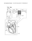 TECHNIQUES FOR PERCUTANEOUS MITRAL VALVE REPLACEMENT AND SEALING diagram and image