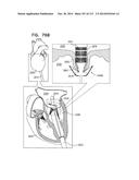 TECHNIQUES FOR PERCUTANEOUS MITRAL VALVE REPLACEMENT AND SEALING diagram and image