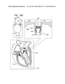 TECHNIQUES FOR PERCUTANEOUS MITRAL VALVE REPLACEMENT AND SEALING diagram and image
