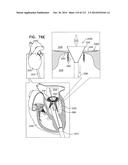 TECHNIQUES FOR PERCUTANEOUS MITRAL VALVE REPLACEMENT AND SEALING diagram and image