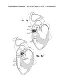 TECHNIQUES FOR PERCUTANEOUS MITRAL VALVE REPLACEMENT AND SEALING diagram and image