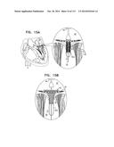 TECHNIQUES FOR PERCUTANEOUS MITRAL VALVE REPLACEMENT AND SEALING diagram and image