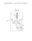 TECHNIQUES FOR PERCUTANEOUS MITRAL VALVE REPLACEMENT AND SEALING diagram and image