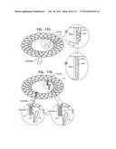 TECHNIQUES FOR PERCUTANEOUS MITRAL VALVE REPLACEMENT AND SEALING diagram and image