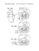 TECHNIQUES FOR PERCUTANEOUS MITRAL VALVE REPLACEMENT AND SEALING diagram and image