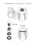 TECHNIQUES FOR PERCUTANEOUS MITRAL VALVE REPLACEMENT AND SEALING diagram and image